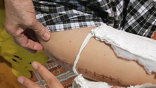  Viện KHHS (Bộ Công an): Giám định thương tích học sinh bị gãy chân