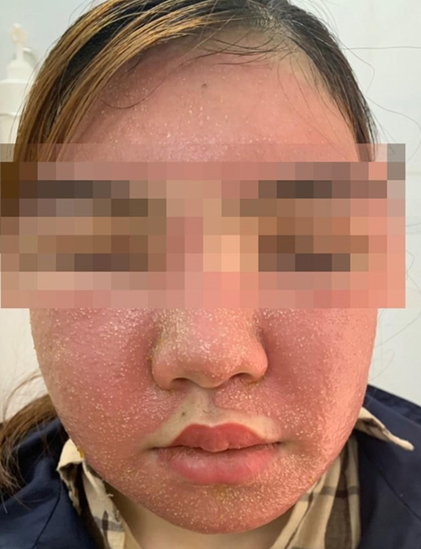 Mặt sưng phù sau khi đắp “mặt nạ” làm trắng da