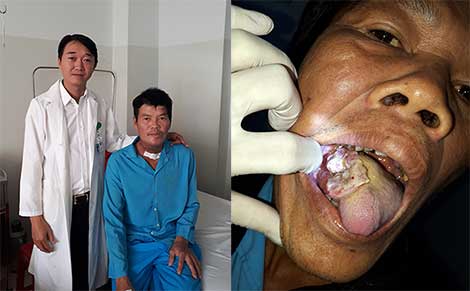 Phẫu thuật thành công ung thư lưỡi bằng vi phẫu tạo hình