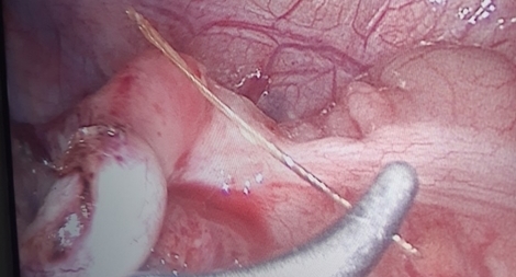 Hi hữu: Xương cá đâm thủng ruột thừa 